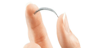 Essure operacion