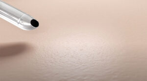 liposuccion y lipofilling con bodyjet